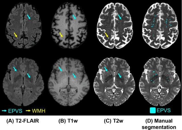 Figure 1 for Standardized Evaluation of Automatic Methods for Perivascular Spaces Segmentation in MRI -- MICCAI 2024 Challenge Results