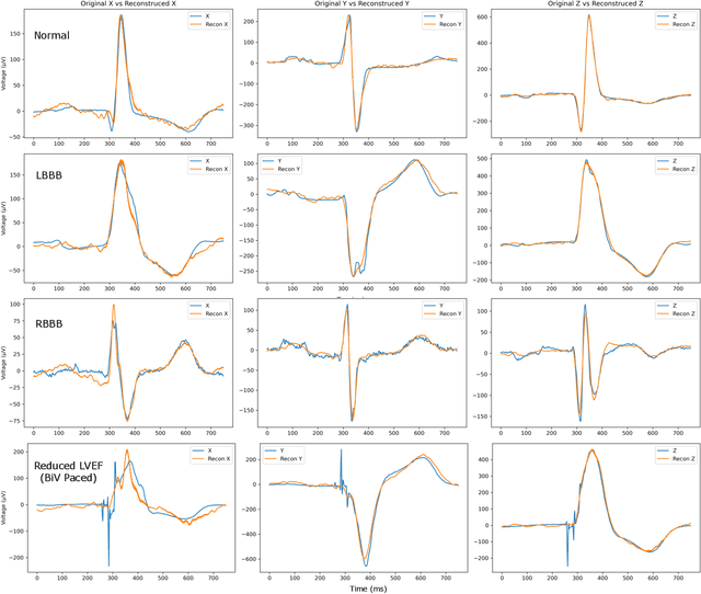 Figure 3 for Comparison of Autoencoder Encodings for ECG Representation in Downstream Prediction Tasks