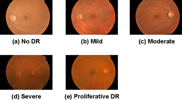 Figure 1 for Brain Storm Optimization Based Swarm Learning for Diabetic Retinopathy Image Classification