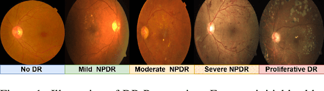 Figure 1 for Divergent Domains, Convergent Grading: Enhancing Generalization in Diabetic Retinopathy Grading