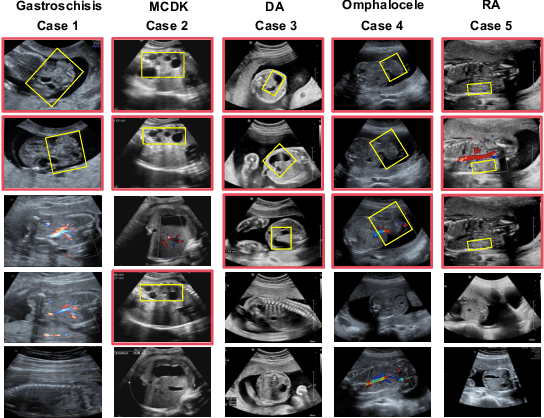 Figure 1 for Medical-Knowledge Driven Multiple Instance Learning for Classifying Severe Abdominal Anomalies on Prenatal Ultrasound