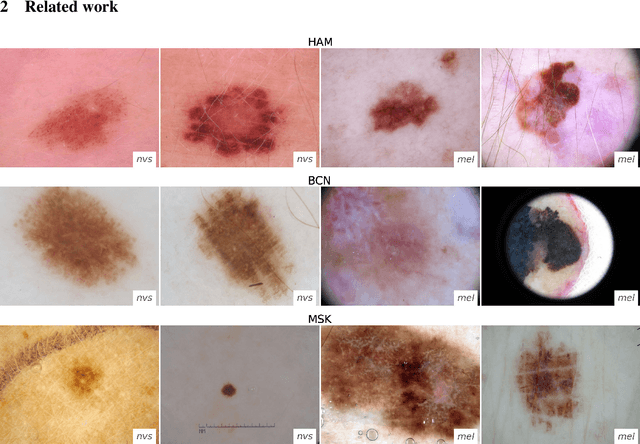 Figure 1 for Domain shifts in dermoscopic skin cancer datasets: Evaluation of essential limitations for clinical translation
