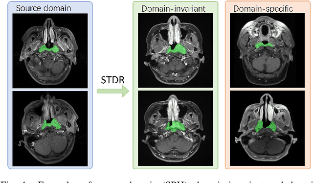 Figure 4 for Dual-Reference Source-Free Active Domain Adaptation for Nasopharyngeal Carcinoma Tumor Segmentation across Multiple Hospitals