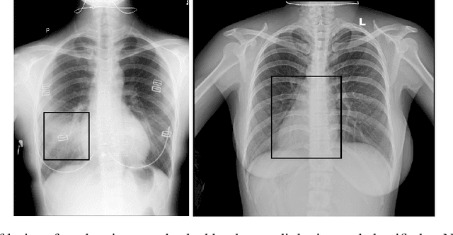 Figure 3 for Prevention is better than cure: a case study of the abnormalities detection in the chest
