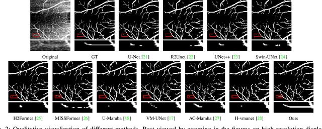 Figure 2 for OCTAMamba: A State-Space Model Approach for Precision OCTA Vasculature Segmentation