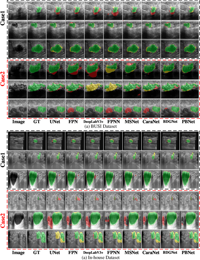 Figure 4 for Multilevel Perception Boundary-guided Network for Breast Lesion Segmentation in Ultrasound Images