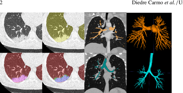Figure 1 for MEDPSeg: End-to-end segmentation of pulmonary structures and lesions in computed tomography