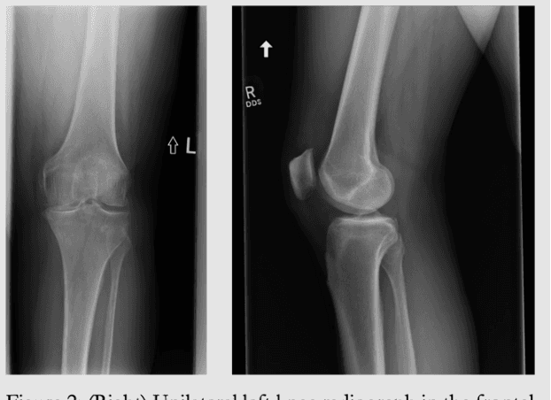 Figure 1 for Emory Knee Radiograph (MRKR) Dataset