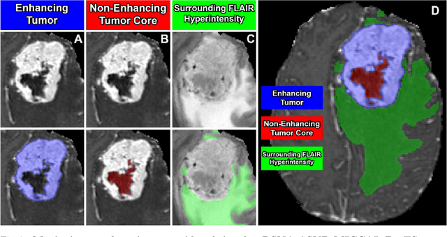 Figure 4 for The ASNR-MICCAI Brain Tumor Segmentation (BraTS) Challenge 2023: Intracranial Meningioma