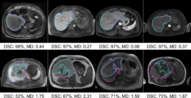 Figure 4 for Dimensionality Reduction and Nearest Neighbors for Improving Out-of-Distribution Detection in Medical Image Segmentation